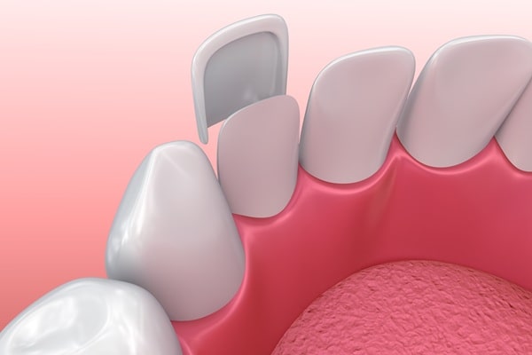 how-veneers-process-works-regina-lakeview-dentalcentre