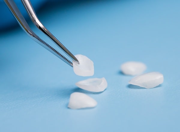 what-can-veneers-fix-regina-lakeview-dentalcentre