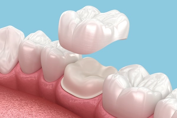 what-crowns-are-made-from-regina-lakeview-dental-centre