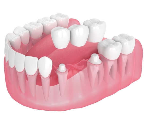 what-we-use-itero-for-regina-lakeview-dental-centre