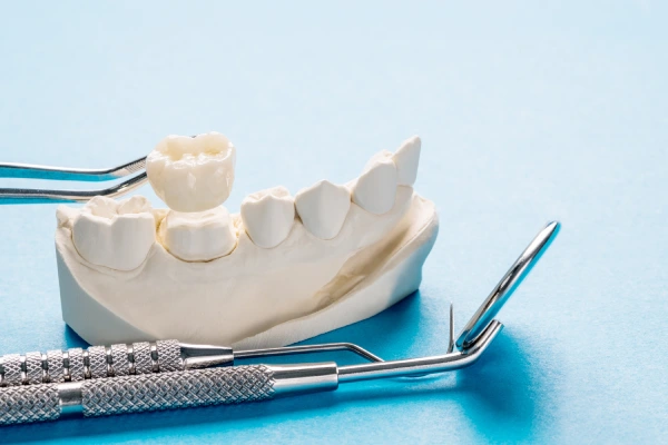 dental-bridges-in-regina